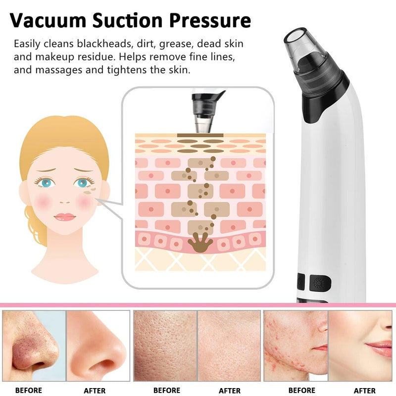 electric pore vacuum, view 7 - MRSLM