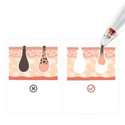 electric rechargeable blackhead remover, view 5 - MRSLM