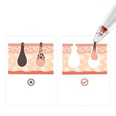 electric rechargeable blackhead remover, view 5 - MRSLM